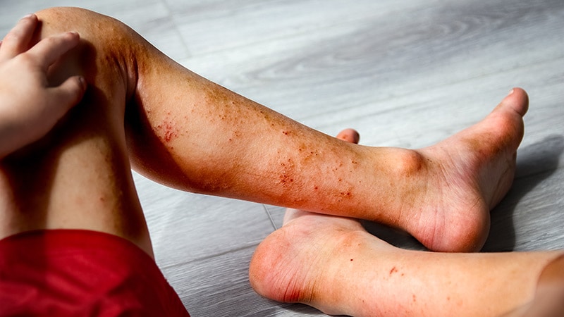 Children With Severe AD Catch Up on Growth With Dupilumab