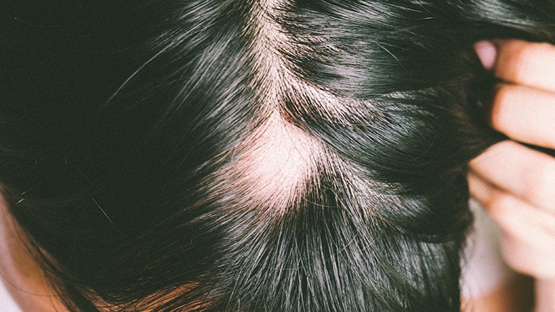 Investigational Alopecia Areata Drug Shows Sustained Effect