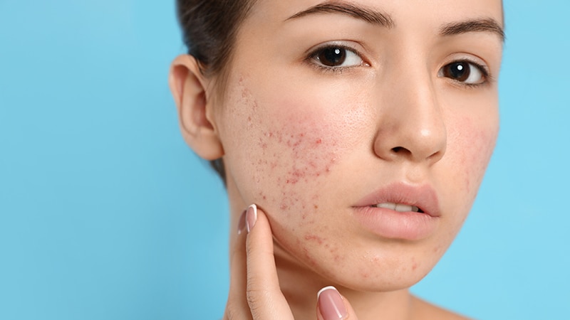 Study Quantifies Acne Risk With JAK Inhibitors for AD