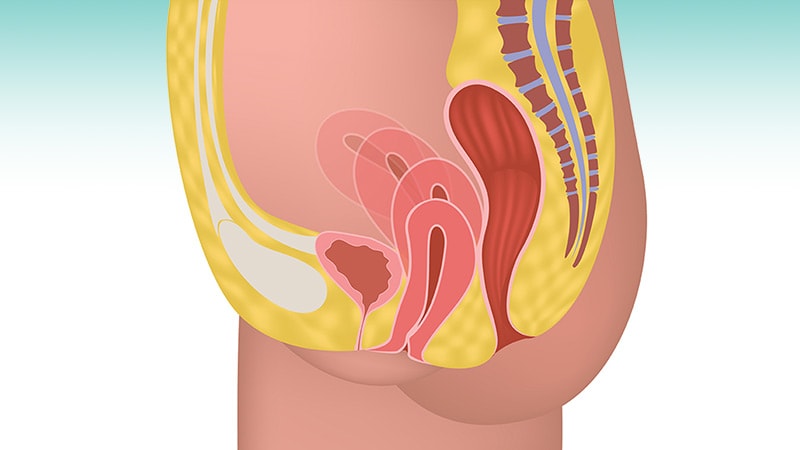 Treating Obesity May Reduce Pelvic Organ Prolapse Risk