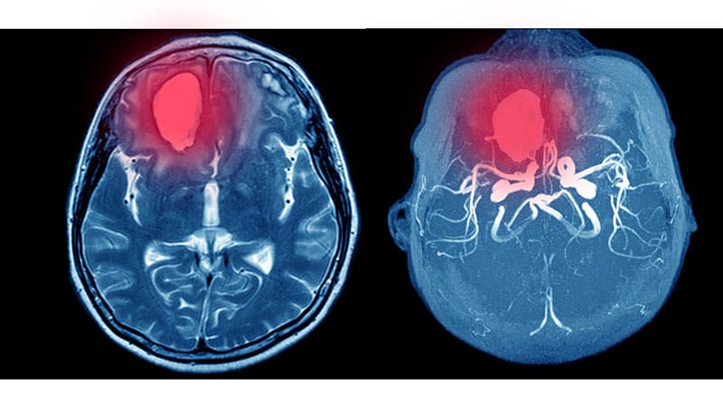 Edoxaban Falls Short After Intracranial Hemorrhage in AF