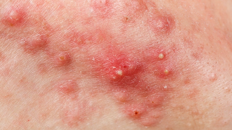 Expert Discusses the ‘Four Pillars of Acne Pathogenesis’