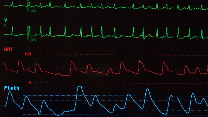 NT-proBNP May Predict Atrial Fibrillation Risk Early