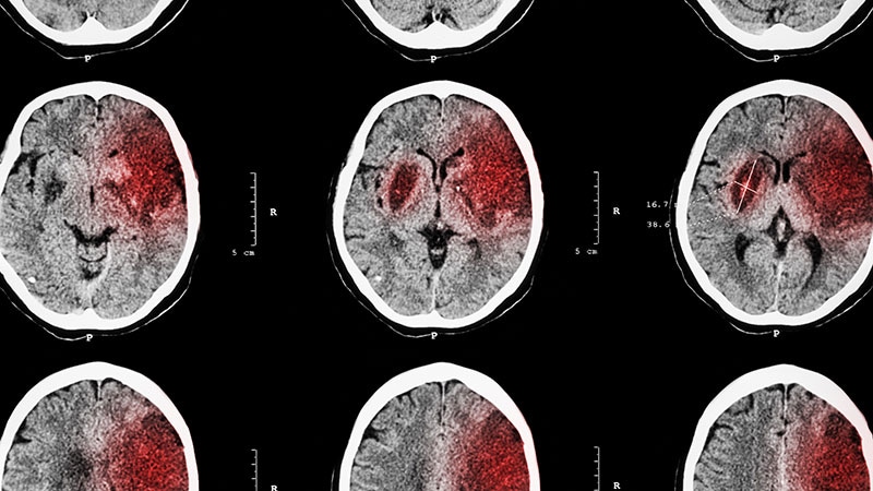 Prourokinase Rivals Alteplase in Acute Stroke Treatment