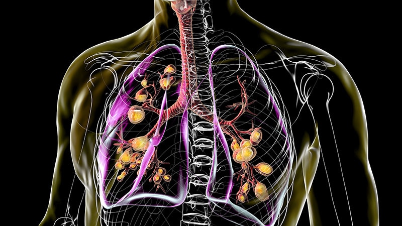 Novel Drug Simplifies Cystic Fibrosis Therapy Routine