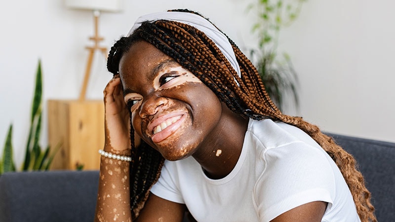 Skilled Highlights Updates in Pediatric Vitiligo Care