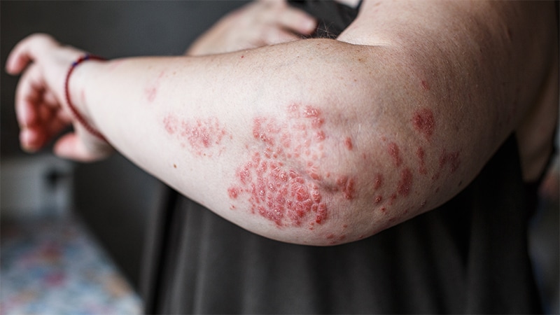 Weight Loss Drugs Show Increasing Benefit in Skin Disease