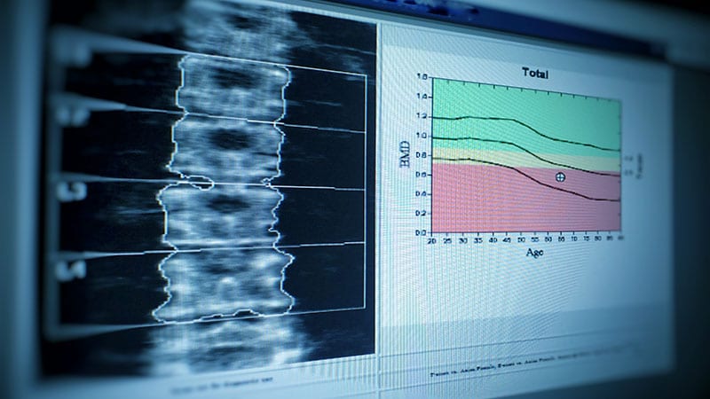 Romosozumab Improves Bone Strength in Women With T2D