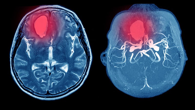 Risk Score May Predict ICH in Anticoagulated Patients