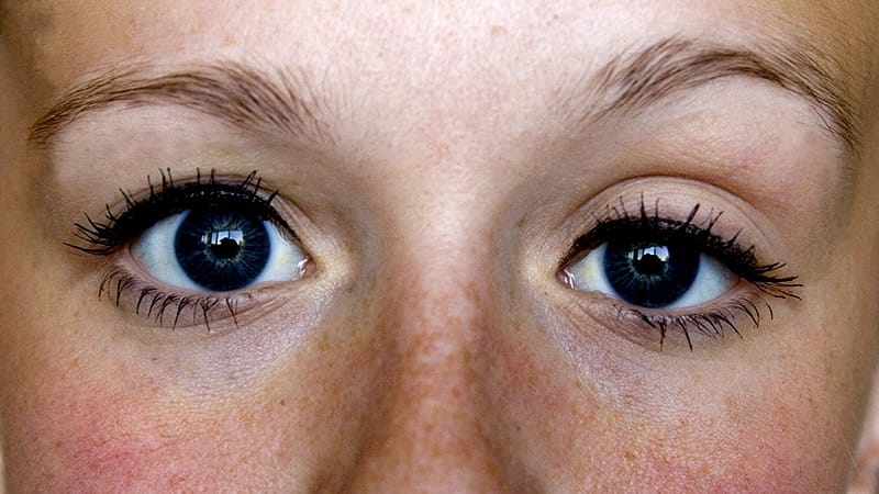 Kids With Congenital Droopy Eyelids More Likely to Have ADHD