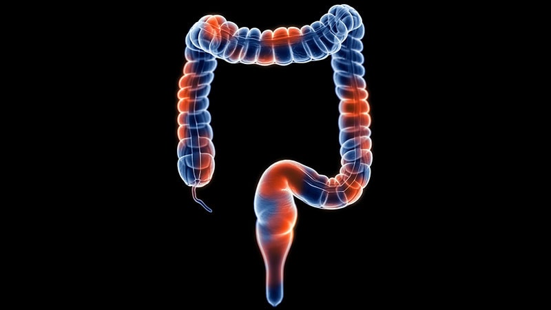 AI Predicts Premature Death in Patients With IBD