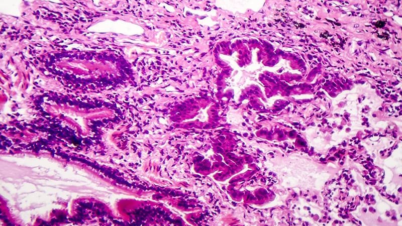 Biomarkers Offer Clues to Prognoses in Lung Adenocarcinoma