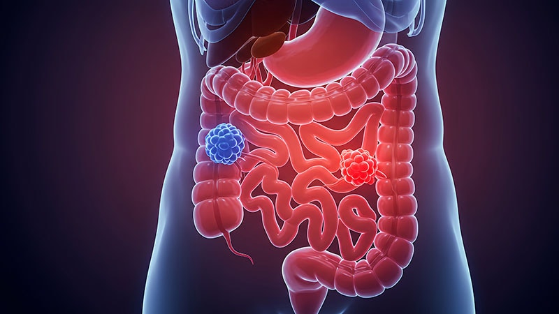 Early-Onset CRC Rises Despite Stable Overall Incidence in UK