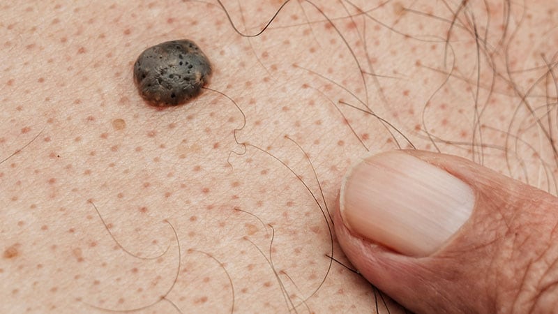 Surgeon Reviews Options for Superficial Skin Cancer