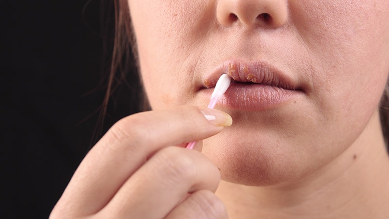 Cold Sore Virus Implicated in Alzheimer’s Disease