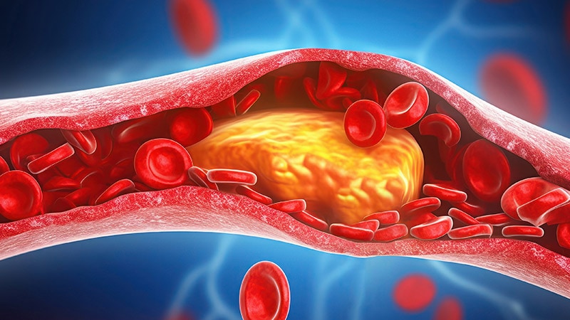 EVT Shows Promise in Select Distal/Medium Artery Strokes