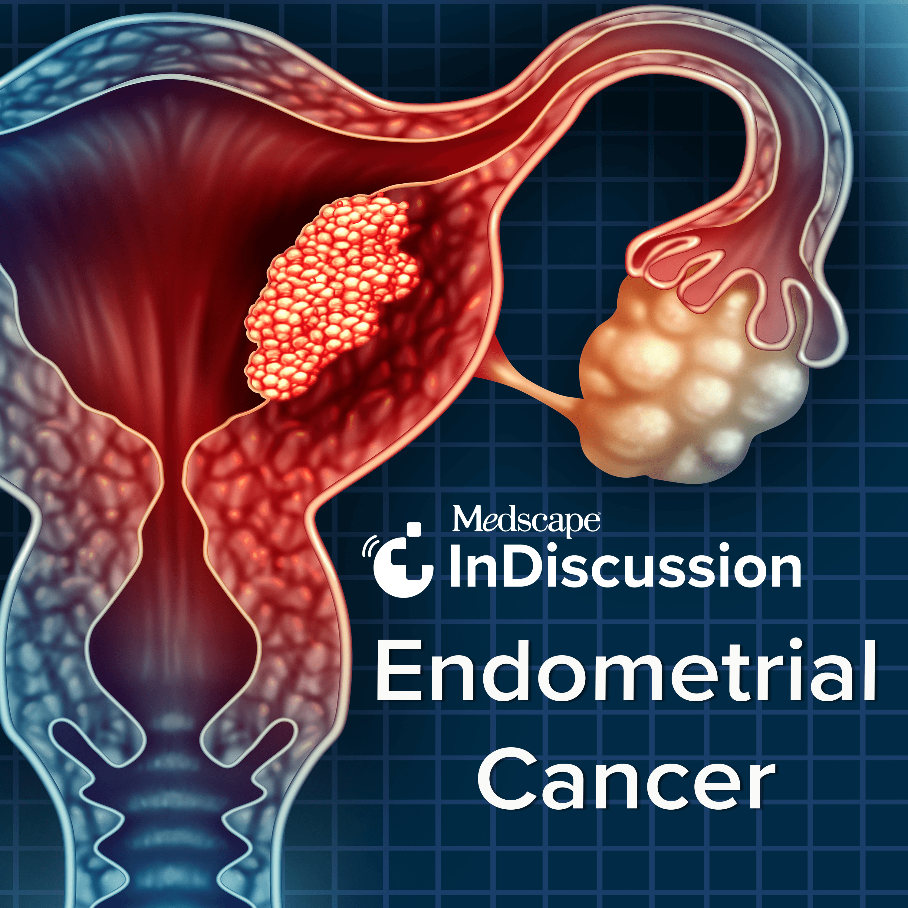 InDiscussion Endometrial Cancer Show Image