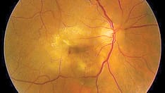 tirzepatide and glaucoma Is Tirzepatide Easier on the Eyes Than GLP-1s?