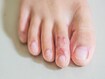 photo of  tinea pedis