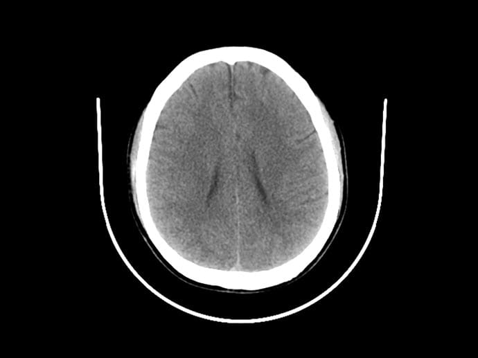 A 26-Year-Old With Abnormal Eye Movement and Agitated Delirium