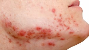 erbitux rash pictures