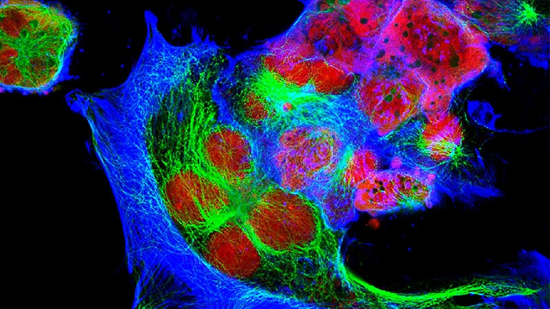 CAR T Anti-GD2 Shows Promise in Paediatric Neuroblastoma