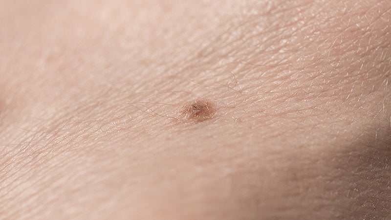 AI Tool for Skin Cancer Triage Gets Conditional NHS Approval
