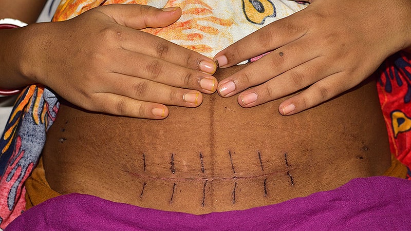 Nonsurgical Protocol Yields High Keloid Resolution