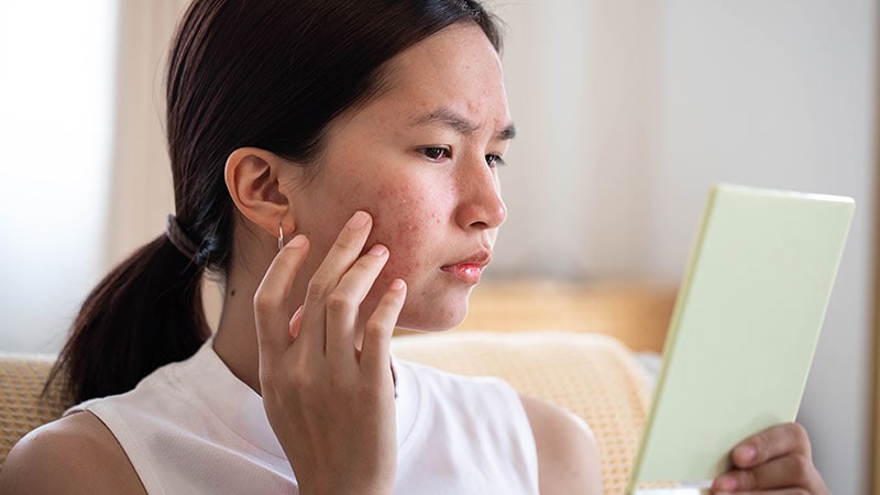 Prior Acne Predicts Breakouts With JAK Inhibitors in AA