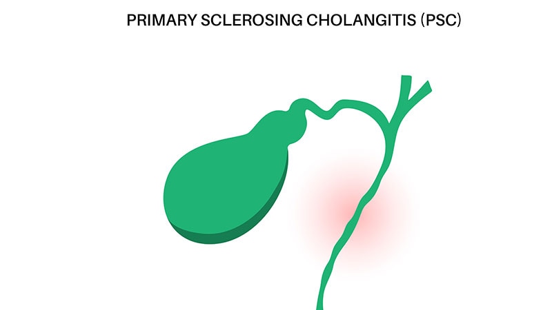 Drug Slows Progression of Primary Sclerosing Cholangitis