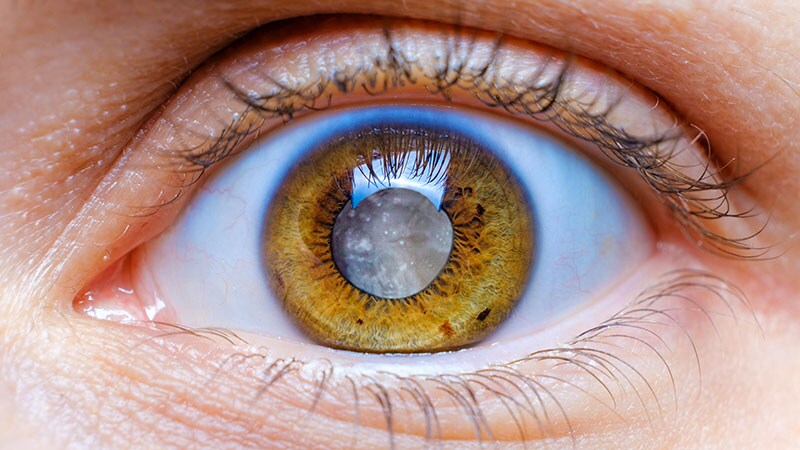 Office-Based Cataract Surgery Measures Up To ASC Cases