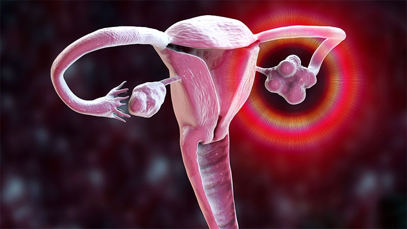 Ketone Supplement Can Help Control Androgen Levels in PCOS