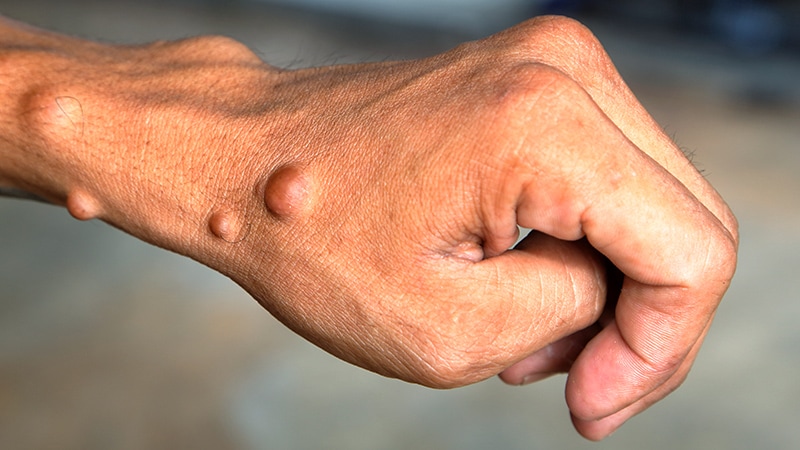 Irish Drug Ezmekly Gets EU Nod for Plexiform Neurofibromas