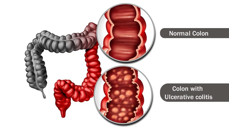 Obefazimod: Long-Term Ulcerative Colitis Relief