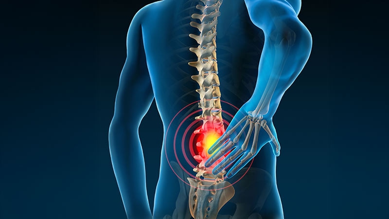 Nonsurgical Options Show Modest Benefit in Chronic Back Pain