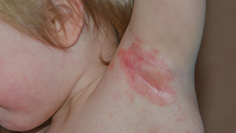 Pediatric HS Linked to Obesity, Acne, Other Comorbidities