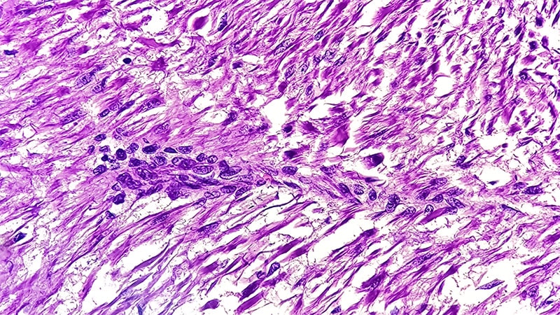 Avelumab Plus Axitinib Shows Promise in Advanced GIST