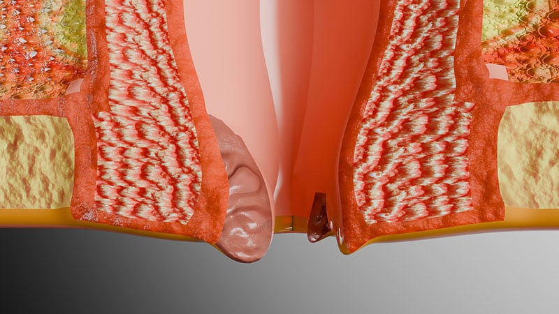 Anal Cancer Screening Benefits HIV-Positive MSM at Age 35