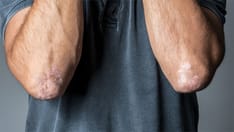Johnson & Johnson's Oral Psoriasis Pill Gets FDA Approval