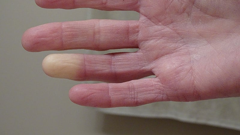 Puffy Fingers or Hands Often Precede Raynaud in SSc
