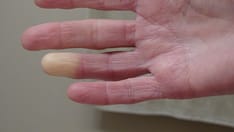 Raynaud Phenomenon Tied to Elevated Cardiovascular Risk