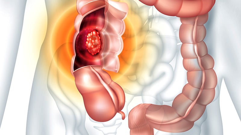 Which Second-Line Therapy Is Better for Right-Sided CRC?