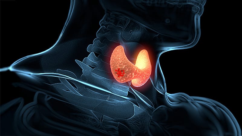 El dilema del cáncer de tiroides: más no siempre es mejor