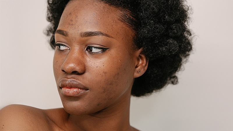 Acne in People With Skin of Color: Key Considerations