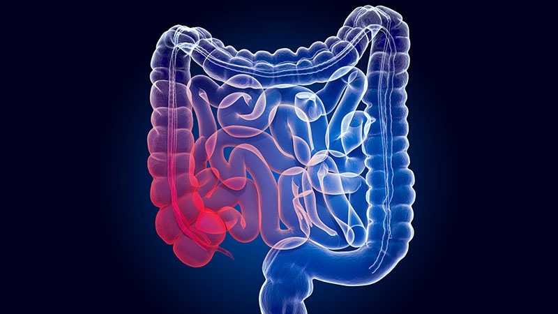 Patients With IBD and PSC Face Elevated CRC Risk
