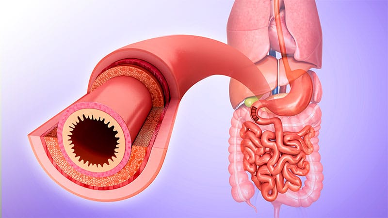 Transmural Healing May Boost Ulcerative Colitis Outcomes