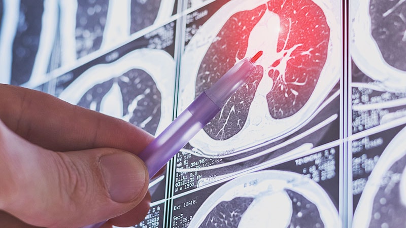 CT Radiomics Differentiates Lung Tumourlets From Granulomas