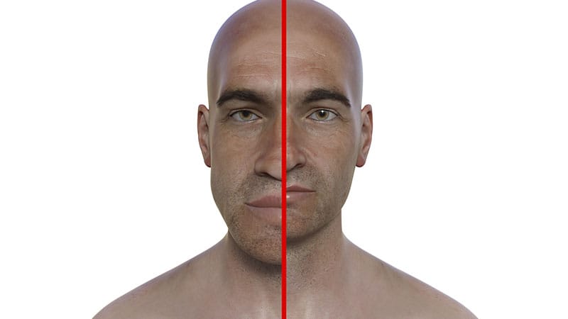 Patients With Acromegaly Have Higher Risk for Cancer