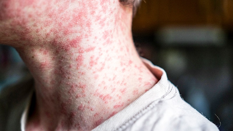 More Measles Cases Hit South Carolina