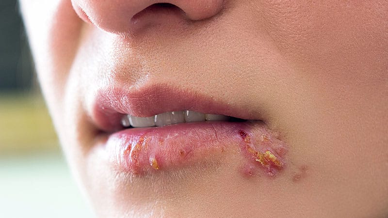 Pritelivir Shows Promise for HSV